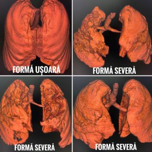 Apelul disperat al medicilor: Nu vă jucați cu sănătatea!